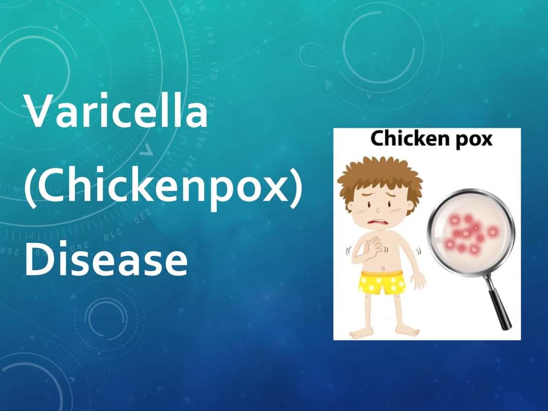 Chickenpox भारत में बढ़ रहा है चिकनपॉक्स का खतरा, जानें लक्षण व बचाव!